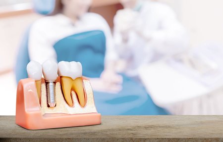 5 mituri despre implantul dentar