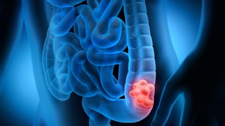 Noi reguli pentru depistarea precoce a cancerului de colon: Ministerul Sanatatii propune o noua metodologie