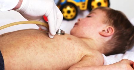 Peste 760 de cazuri noi de rujeola, in ultima saptamana. Un bebelus din Bucuresti, nevaccinat, a murit