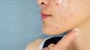 <span style='background:#EDF514'>CAUZELE</span> aparitiei acneii fungice. Simptome si tratament