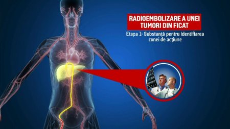 Premiera medicala in Romania. Un pacient bolnav de cancer de ficat a fost tratat cu ajutorul radioembolizarii