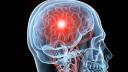 Senzor implantat in creier care ar putea detecta cancerul