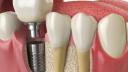 Implanturile Dentare: O Solutie Moderna pentru Sanatatea Orala