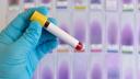 Romania, fruntasa in Europa la numarul cazurilor de hepatita. Specialistii cer ca toate testele sa fie acoperite de stat