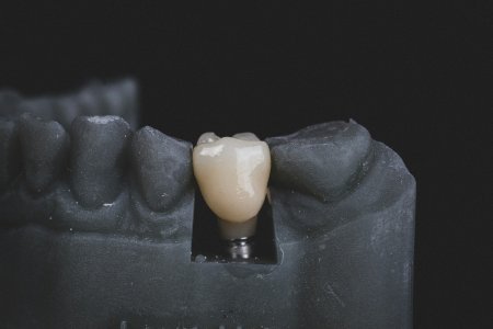 Totul despre ingrijirea dupa implant dentar: Sfaturi si Recomandari