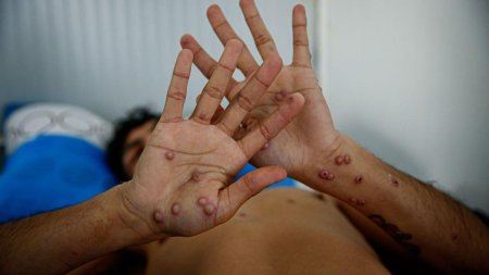 Variola maimutei: OMS a declarat epidemie de mpox, o urgenta de sanatate publica de interes international