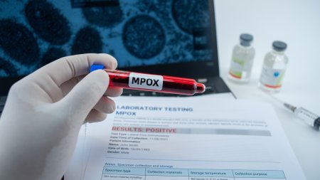 A fost raportat primul caz de infectare cu o varianta mai contagioasa de mpox din afara Africii