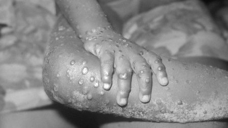 Primul caz de mpox a fost inregistrat in Thailanda. Tulpina africana confirmata la pacient e cea responsabila pentru epidemia actuala