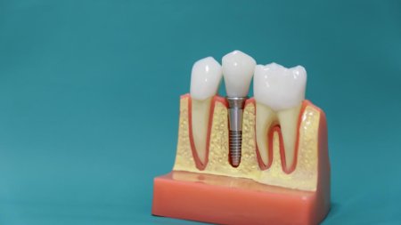 Implantul dentar, o procedura stomatologica de ultima generatie