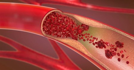 Samanta care previne accidentele vasculare cerebrale si tromboza. Poate fi integrata usor in <span style='background:#EDF514'>ALIMENTATIA</span> zilnica