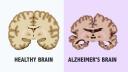 Tratament revolutionar pentru Alzheimer, aprobat si in UE