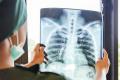 Screening TB pentru 75.001 persoane din comunitati defavorizate