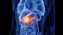 Cercetatorii au identificat o enzima care accelereaza cresterea tumorilor in cancerul pancreatic