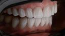 Totul despre fatetele dentare: Estetica si functionalitate la Delta Clinic Dent