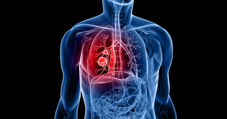 Care este, dupa fumat, al doilea factor de risc pentru cancerul pulmonar