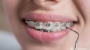 Aparatele dentare invizibile, tot mai populare printre adulti: care sunt beneficiile lor?