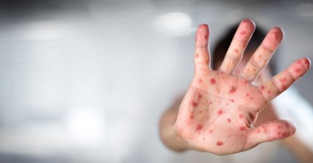 Boala contagioasa care provoaca probleme majore in Romania. Medicii trag un semnal de alarma si spun ca situatia ar putea deveni mai grava