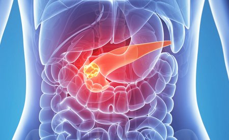 Cancerul pancreatic: doua tratamente combinate si un vaccin ofera rezultate uimitoare