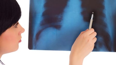 Radiografiile toracice ajuta la depistarea timpurie a cancerului pulmonar