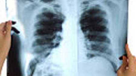 Radiografiile toracice ajuta la depistarea timpurie a cancerului pulmonar